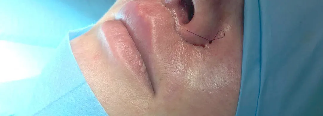 Risks and Complications of Rhinoplasty: What You Need to Know