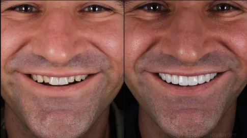 Costos de Carillas Dentales: USA vs Colombia